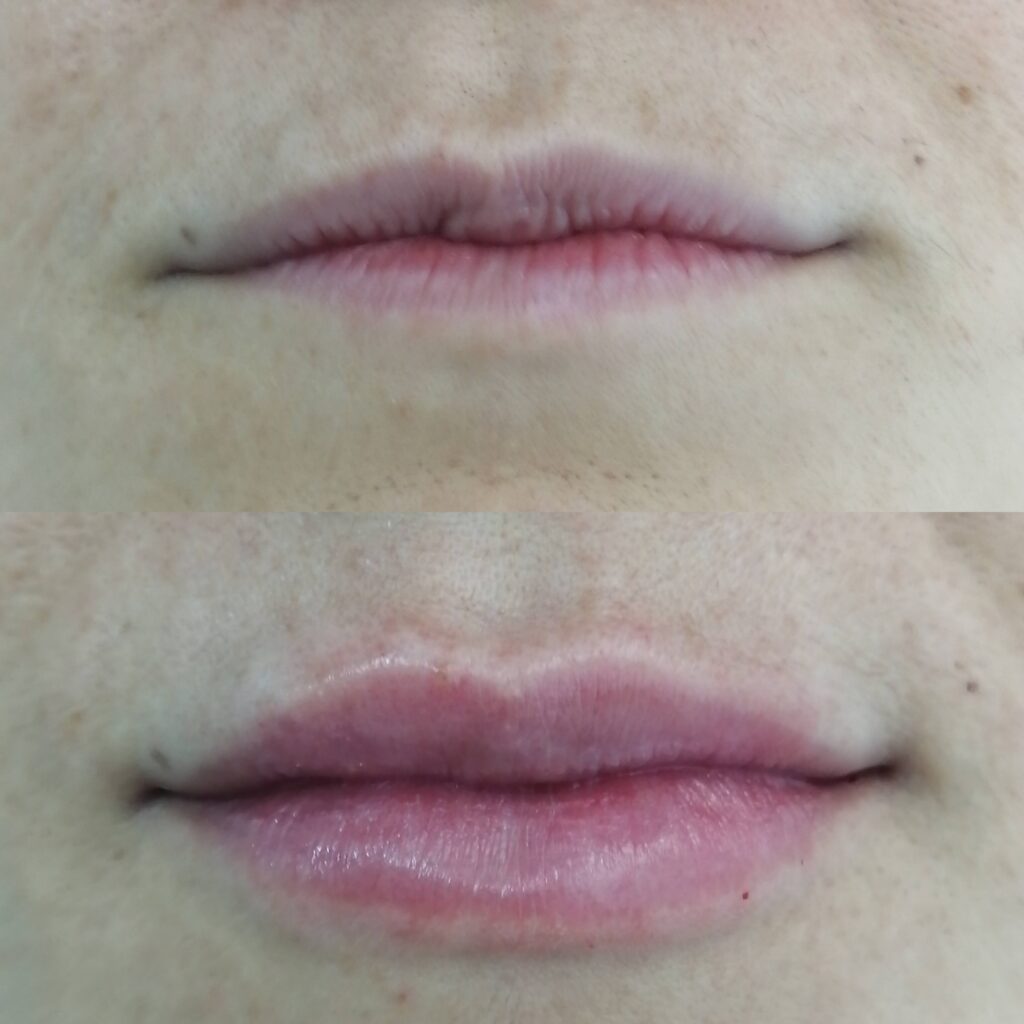 Ácidohialurónico de labios
