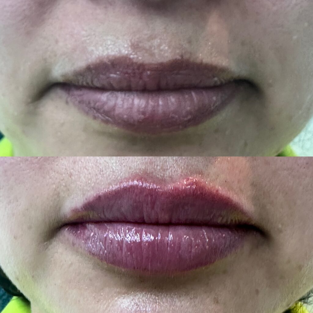 ácido hialurónico labios