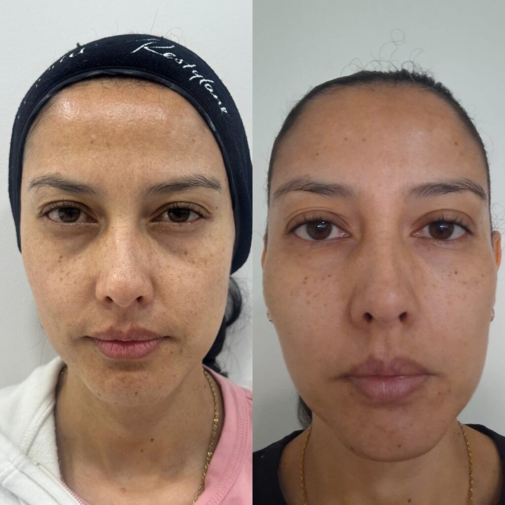 ácidohalurónico ojeras