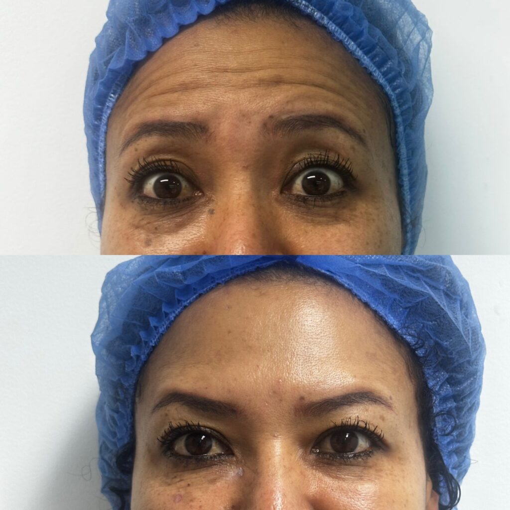 botox