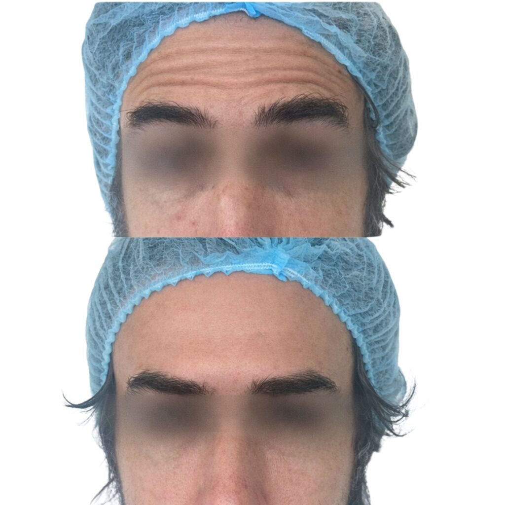 botox (2)